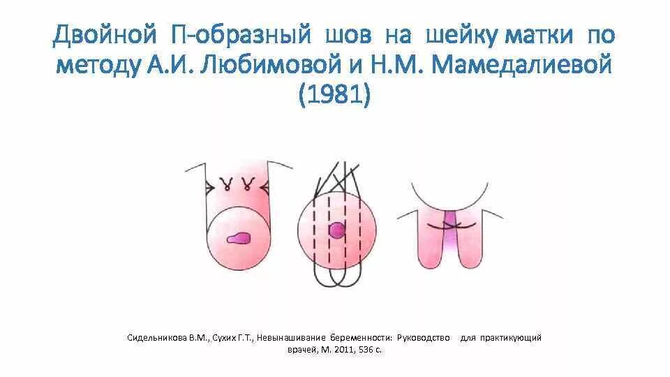 Двойной п образный шов шейки матки. П-образные швы на шейку матки. П оьразный шов при истсмикоцервикальной нежостаточности. Техника наложения швов при истмико цервикальной недостаточности. Швы при ицн