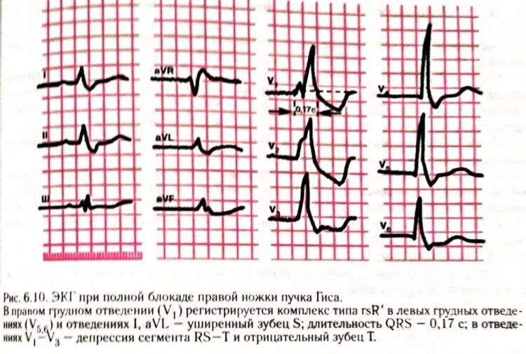 Неполная блокада ножек и ветвей пучка гиса