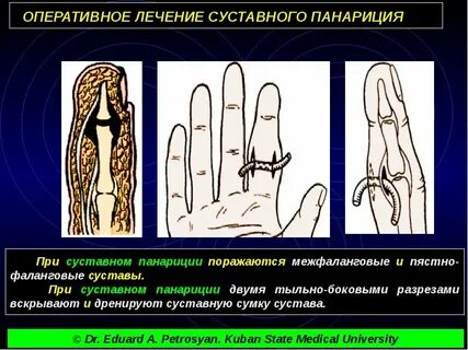 Панариций какая мазь