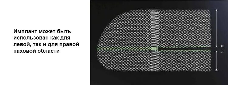 Какую сетку ставят при грыже