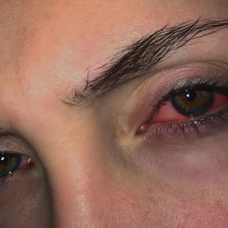 He eyes are red