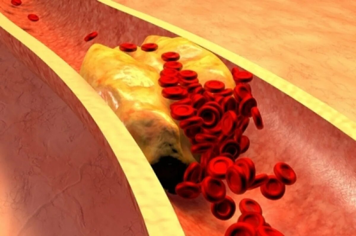 Тромб в кровеносном сосуде. Жировые бляшки в сосудах. Кровяной тромб