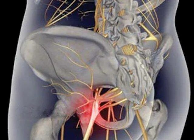 Ишиас - защемление седалищного нерва. Седалищный нерв МСКТ. Воспаление седалищного нерва симптомы у мужчин
