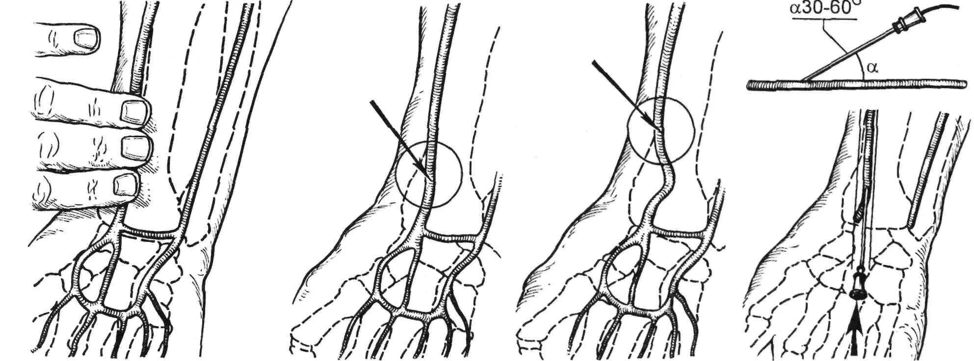 Катетеризация бедренной. Пункция лучевой артерии. Катетеризация бедренной вены техника. Пункция и катетеризация лучевой артерии. Пункция правой лучевой артерии по Сельдингеру.