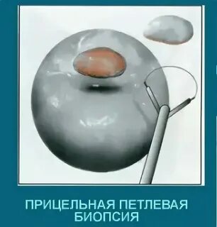 Биопсия матки видео