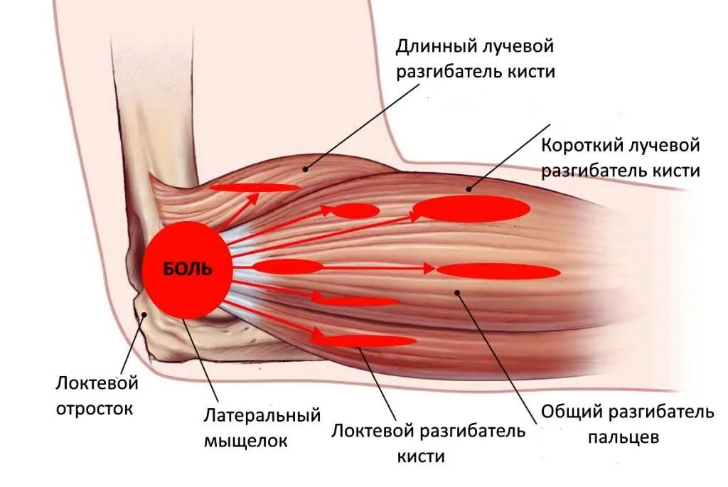 Латеральный эпикондилит локтевого. Мышцы и сухожилия локтевого сустава. Латеральный эпикондилит сухожилие. Сухожилия разгибателей локтевого сустава. Эффективное лечение бурсита локтевого