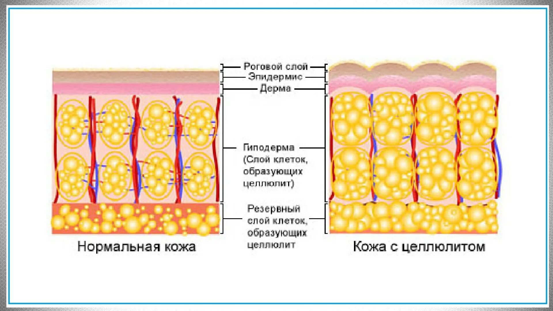 Жировая ткань гиподерма. Целлюлит жировые клетки. Фиброз жировой ткани. Фиброз жировой ткани. Сахарный диабет 1 типа микропрепарат.