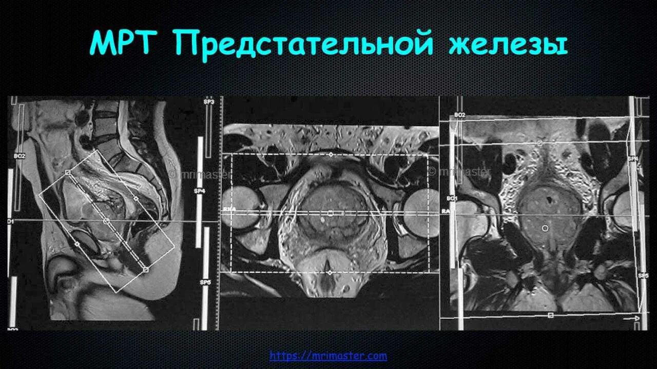 Делают мрт предстательной железы. Мультипараметрическое мрт предстательной железы. мрт снимки аденомы простаты. магнитно-резонансная томографии (мрт) предстательной железы.