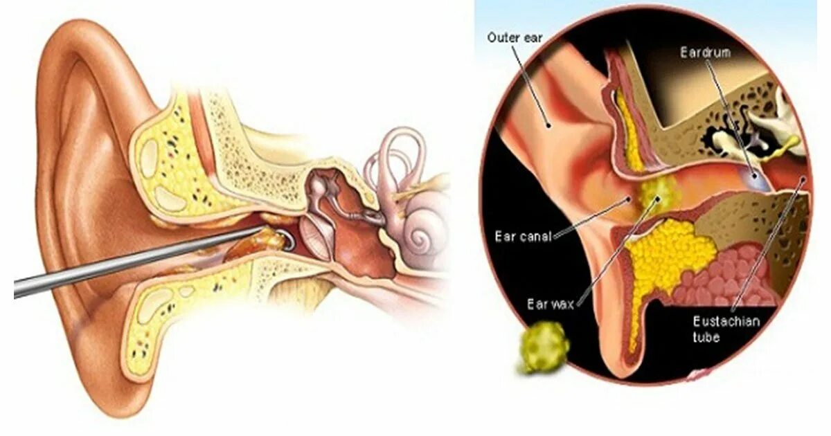 Ухо заложило после чистки палочкой. Отомикоз серная пробка.