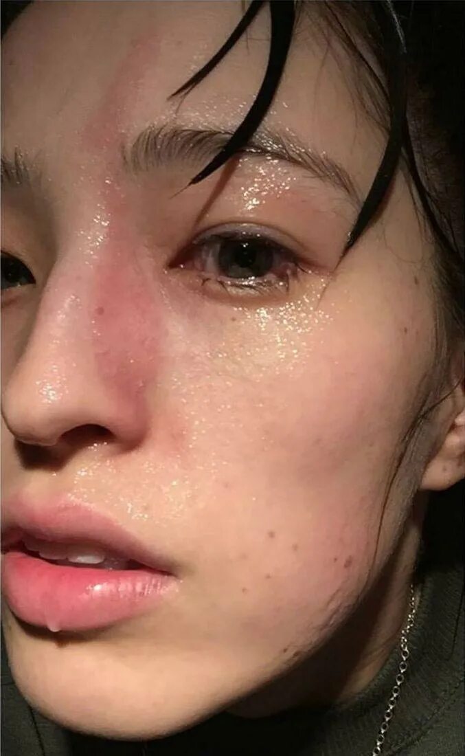 Краснеть от смущения. Почему у человека горит лицо. Розацеа телеангиэктазии. Почему жжет лицо. Розацеа эритематозная стадия.