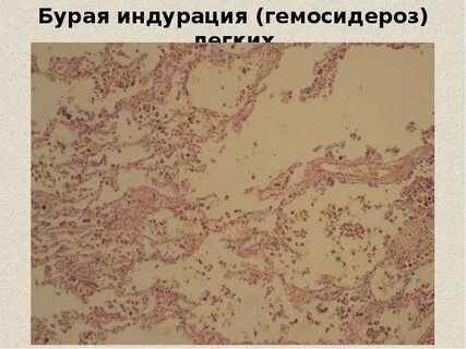 Гемосидероз это