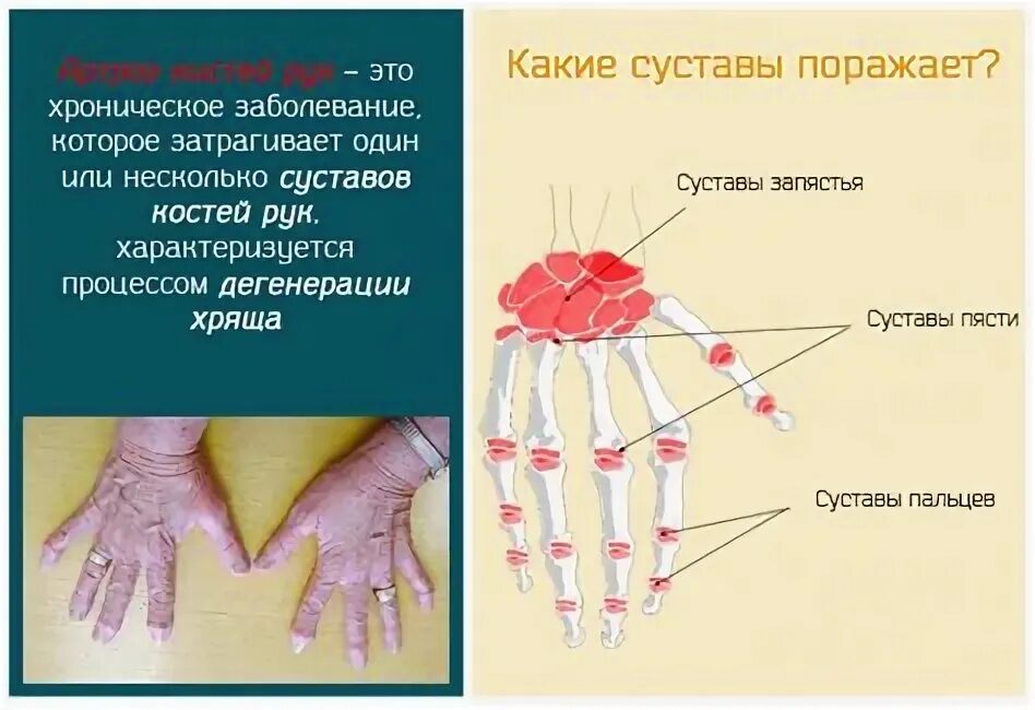 Скованность пальцев кисти. Поражение кожи при системной склеродермии. Скованность пальцев кисти. Ревматоидный артрит опухание рук. Лигаментит пальца кисти.