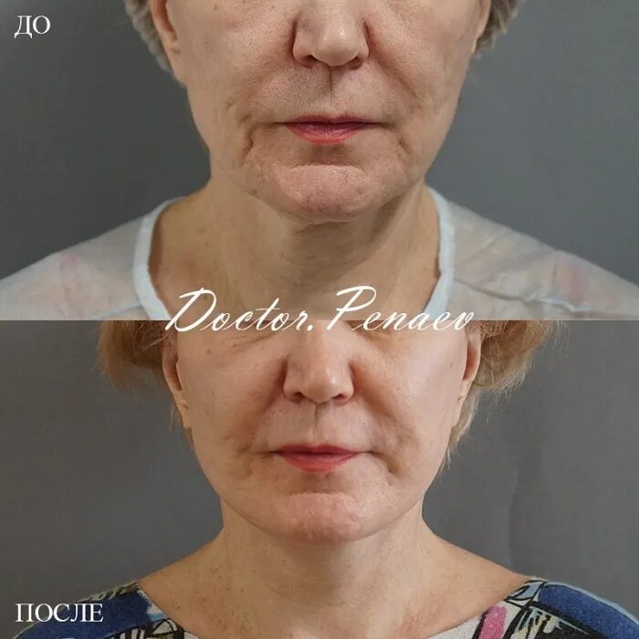 меган анатомия страсти. пациентка 65 лет. эндотины для лица фото. врач фото. пациентка 65 лет.