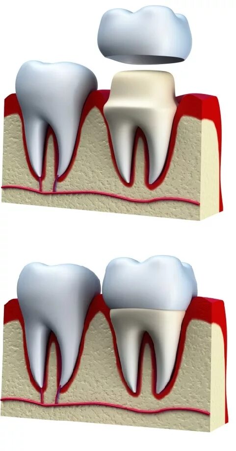 Зуб с короной. Стоматологические коронки. Установление коронки на зуб. Как ставят коронку на зуб.