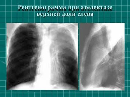 Ателектаз правой доли легких