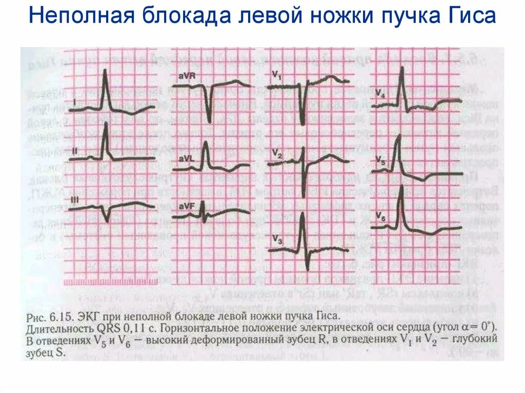 Блокада ножки гиса симптомы. Неполная блокада левой ножки ЭКГ критерии. Неполная блокада левой ножки пучка Гиса на ЭКГ. ЭКГ при неполной блокаде левой ножки пучка Гиса. Признаки неполной блокады левой ножки пучка Гиса на ЭКГ.