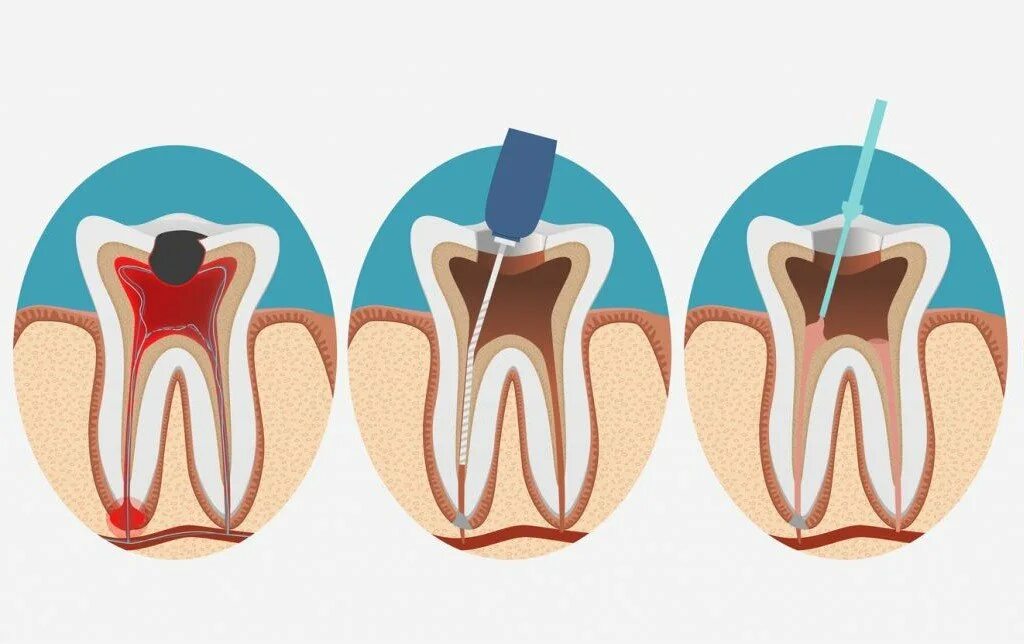 Восстановление после эндодонтического лечения. Пульпита (депульпирование зуба. Витальная экстирпация пульпы. Пульпит 2 канального зуба. Пульпит трехканального зуба.