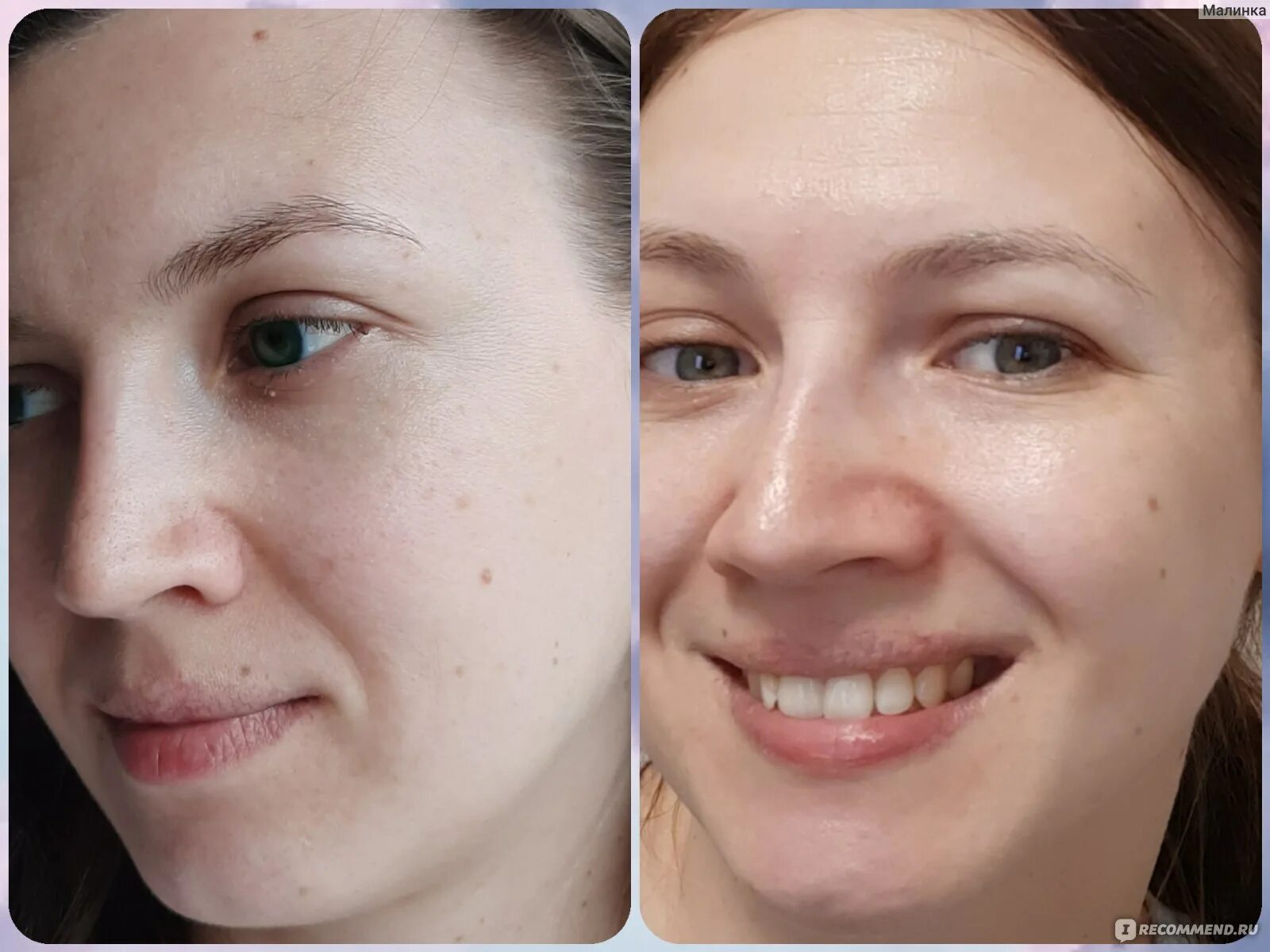 Коллаген лицо до и после. Эффект от коллагена для кожи.