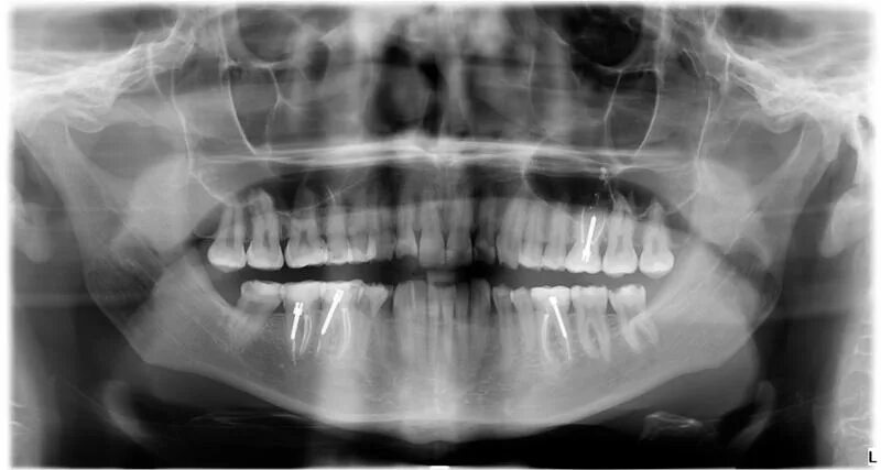 Снимок зубов видное. Кариес зубов на снимке рентген.
