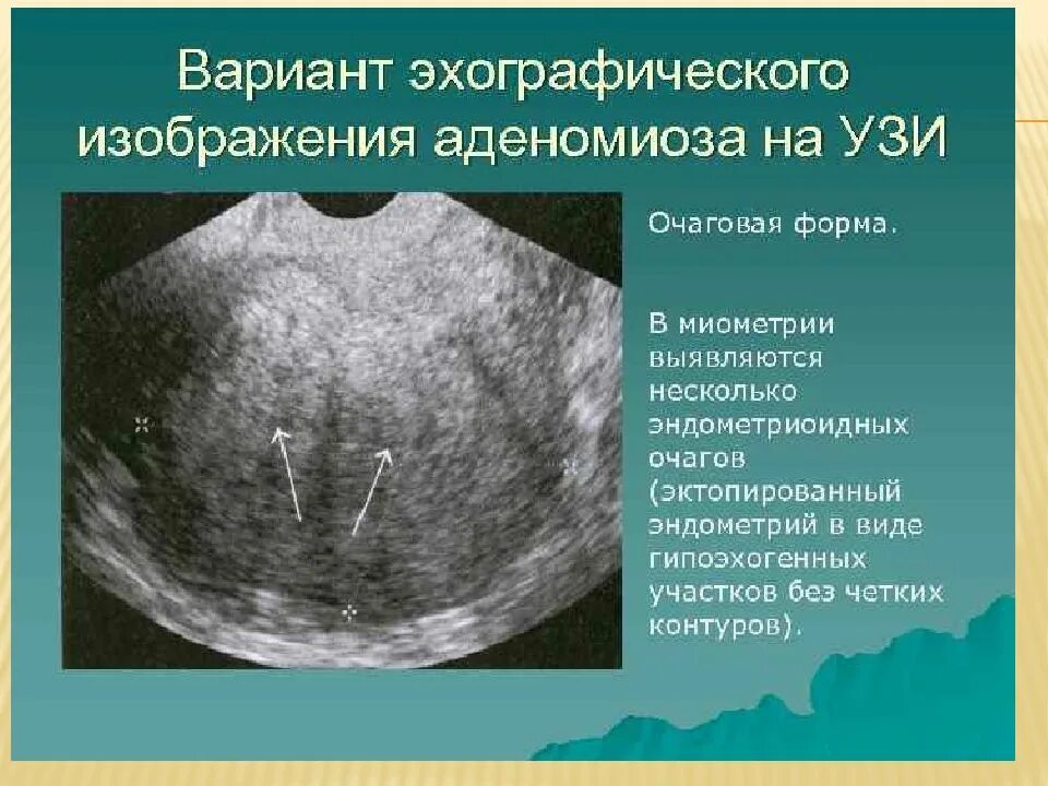 Матка 37 мм. Очаговый аденомиоз на УЗИ. Диффузно Узловая форма эндометриоза. Узловая форма аденомиоза по УЗИ.