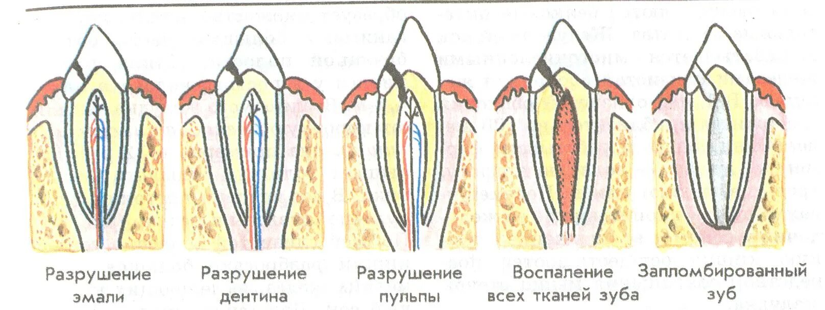 Разрушение ткани зуба