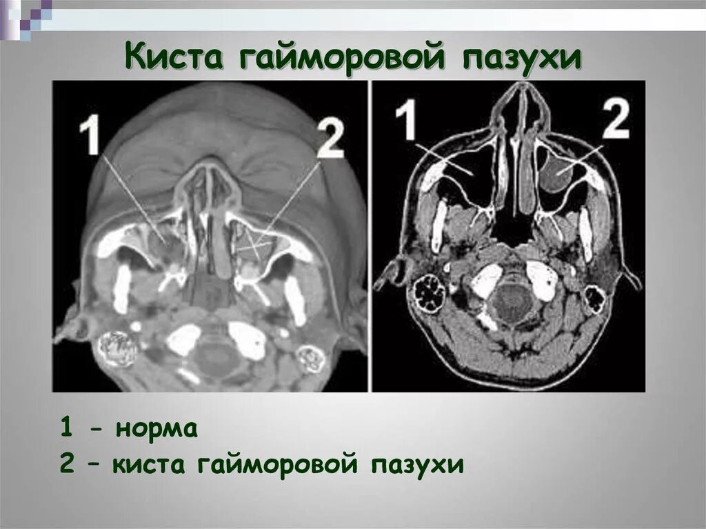 Киста правой верхнечелюстной пазухи