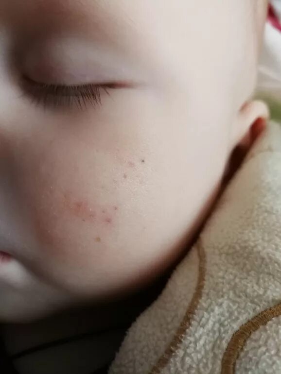 Как выглядят прыщи у детей Bambina Con Varicella Foto stock Getty Images