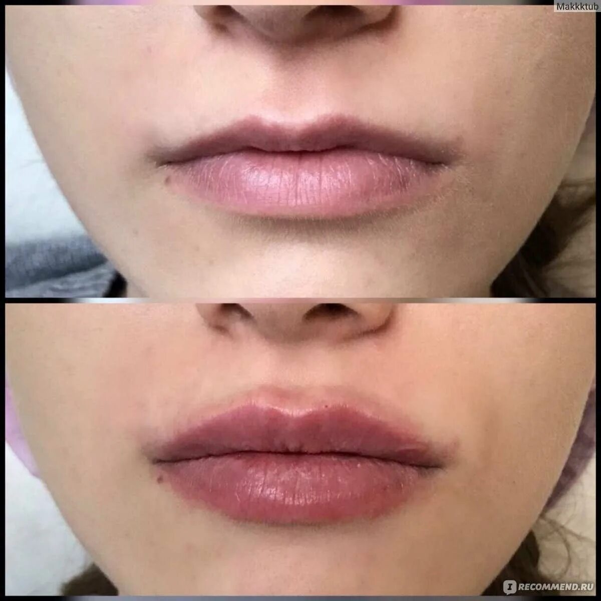 Губы с 0. Накачивание губ гиалуроновой кислотой 0. Губы 05. 5 мл. Губы 05.