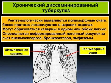 Диссеминированного туберкулеза легких