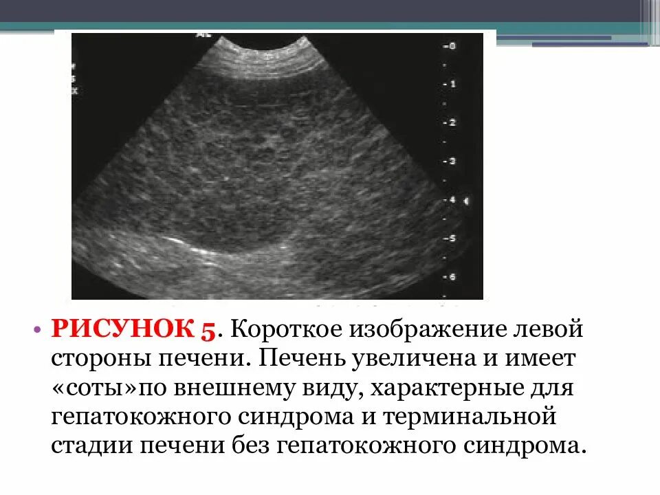 Печень увеличена на узи причины у взрослых. Крупнозернистая структура печени. узлы регенерации печени при циррозе на узи. внешний вид увеличенной печени.