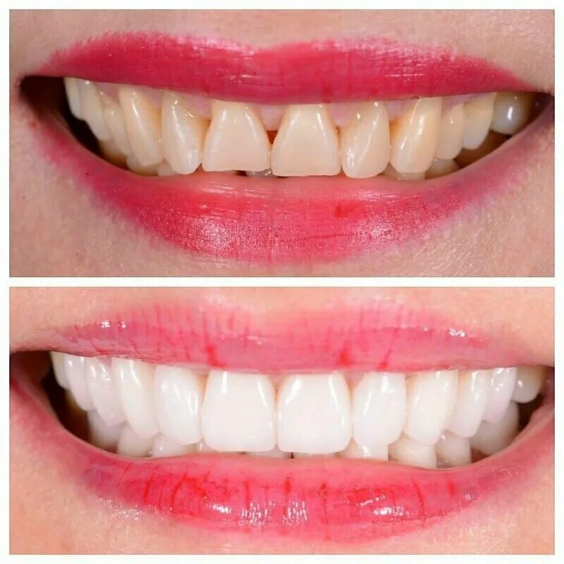 вильвета и винир