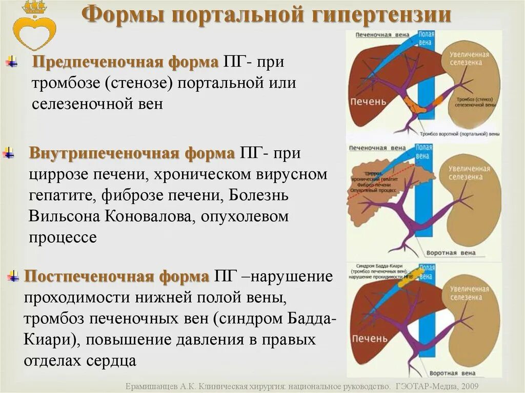 Расширение воротной вены