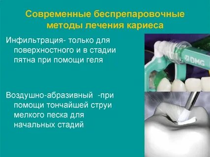 Методы лечения кариеса