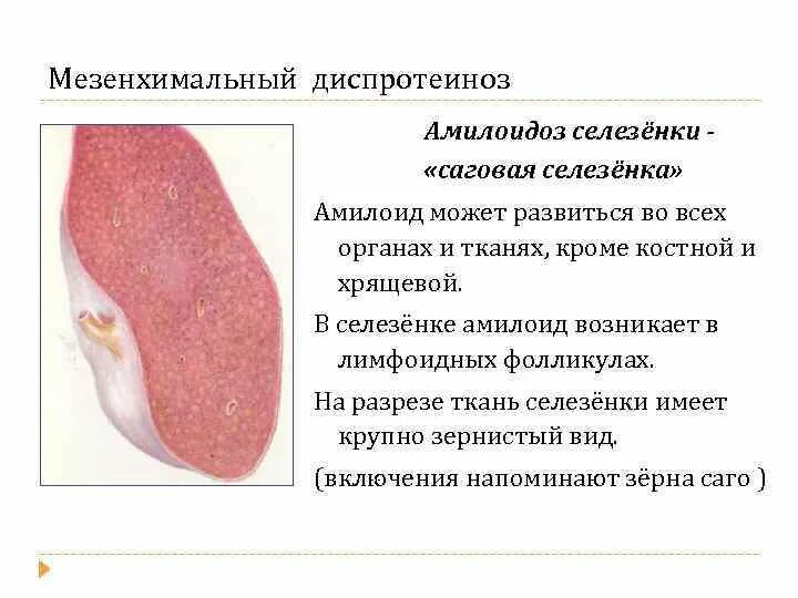 Саговый амилоидоз селезенки. Амилоидоз селезенки окраска конго красным. Амилоидоз селезенки саговая селезенка микропрепарат. Амилоидоз селезенки макропрепарат саговая. Амилоидоз селезенки макропрепарат.