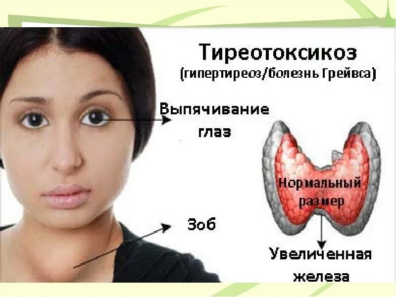 Гипертиреоз щитовидной железы симптомы. Тиреотоксикоз щитовидной железы. Щитовидка тиреотоксикоз. Тиреотоксикоз гиперфункция щитовидной железы.