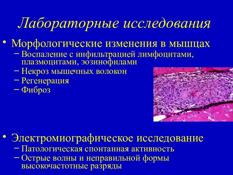 Аутоиммунный дерматомиозит. Дерматомиозит патологическая анатомия. Морфологические изменения. Воспалительная инфильтрация лейкоцитами. Полимиозит что это