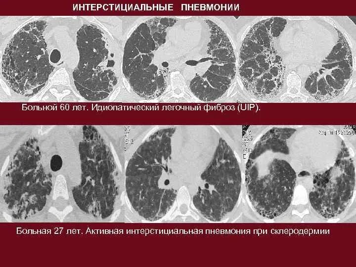 Фиброз после ковида. Идиопатический легочный фиброз кт. Интерстициальный фиброз на кт. Острая интерстициальная пневмония кт. Лимфоидная интерстициальная пневмония кт.