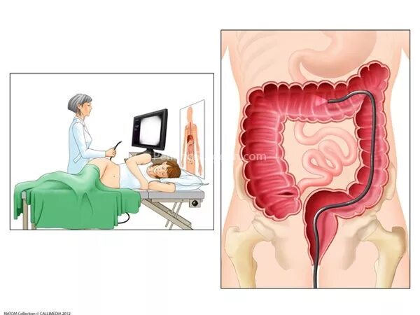 Ректоскопия, ректороманоскопия, колоноскопия. Обследование кишечника колоноскопия. Полипы толстой кишки колоноскопия. Колоноскопия ободочной кишки. Процедура эндоскопия кишечника