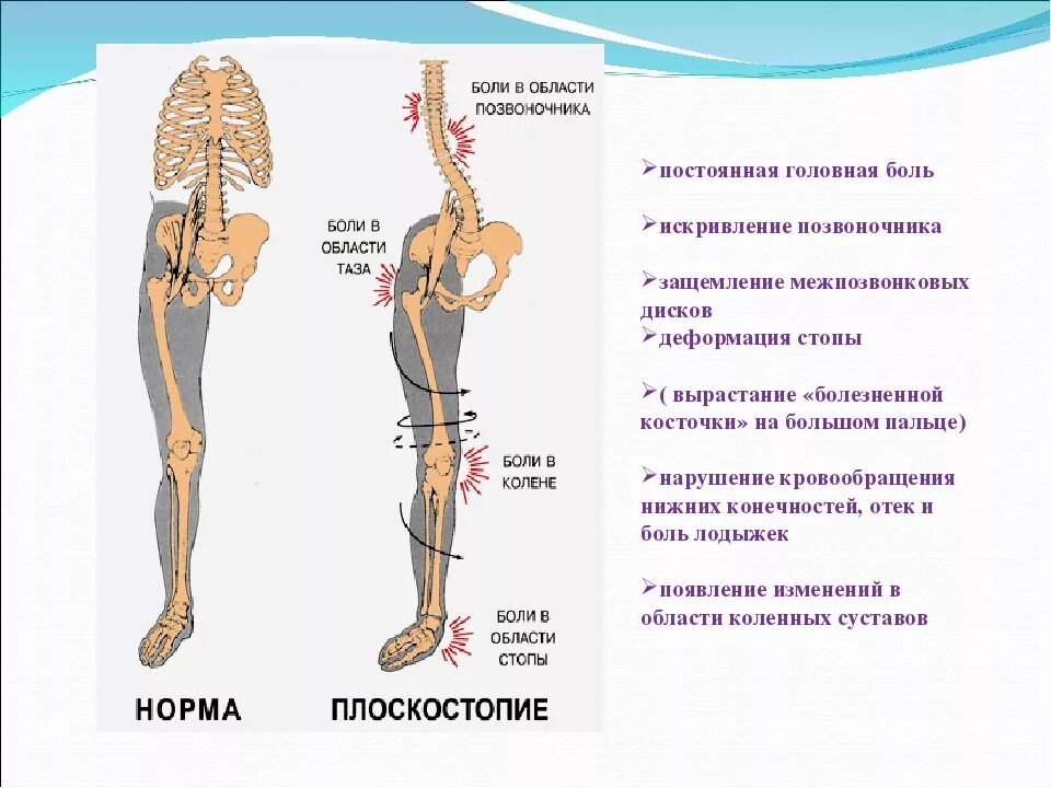 Боли в костях поясницы. Плоскостопие и позвоночник связь. Стопы и позвоночник взаимосвязь. Плоскостопие искривление таза.