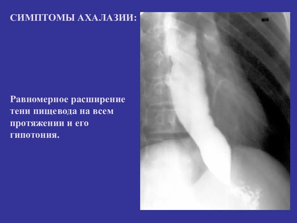 Признаки пищевода. Ахалазия пищевода рентгенодиагностика. Халазия пищевода синдром. Ахалазия желудка рентген. Симптомы ахалазии пищевода.