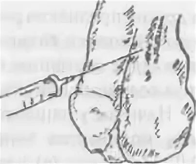 Блокады половые. Новокаиновая блокада по Лорин-Эпштейну. Блокада семенного канатика по Лорин-Эпштейну. Блокада по Лорин-Эпштейну техника. Блокада семенного канатика показания.
