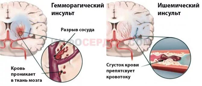 Инсульт предынсультное состояние. Симптомы прединсультного состояния. Пред инсулное состояние. Предынсультное состояние симптомы.