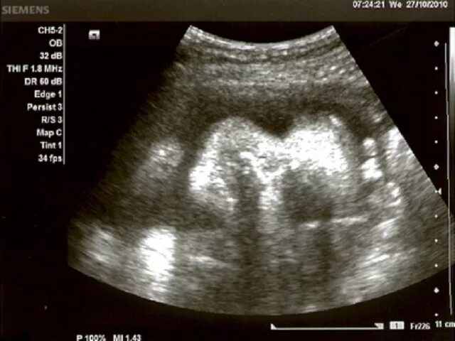 узи плодное яйцо 6 недель. когда видно плод на узи. узи в плодном яйце 2 эмбриона. плод на 5 неделе беременности узи. эмбрион не визуализируется на 6 неделе.