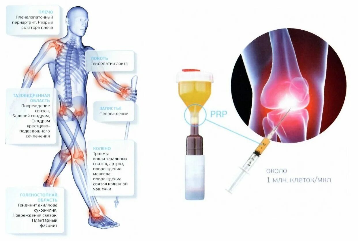 Плазмолифтинг колена отзывы. Плазмолифтинг PRP терапия. PRP терапия Platelet Rich Plasma. Плазмолифтинг PRP терапия коленного сустава. PRP терапия в ортопедии и травматологии.