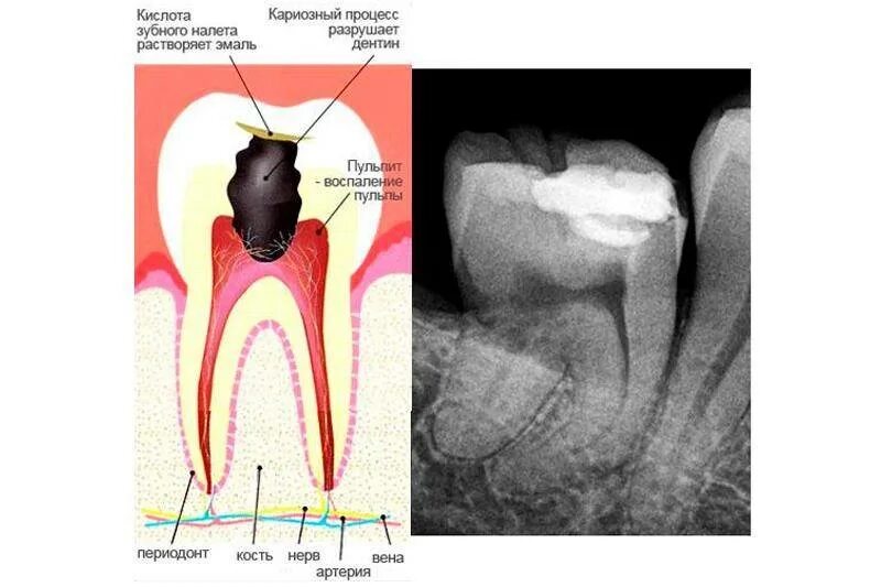 пульпит зуба диагностика. пульпит зуба классификация острый. периодонтит и пульпит разница. пульпит зуба диагностика. пульпит зуба диагностика.