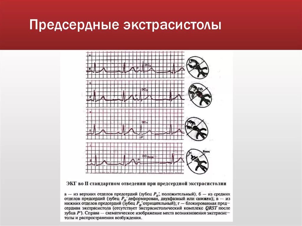 Экстрасистола предсердия на ЭКГ. Предсердная экстрасистолия на ЭКГ. Предсердные экстрасистолы на ЭКГ. ЭКГ при экстрасистолии предсердий. 10 экстрасистола