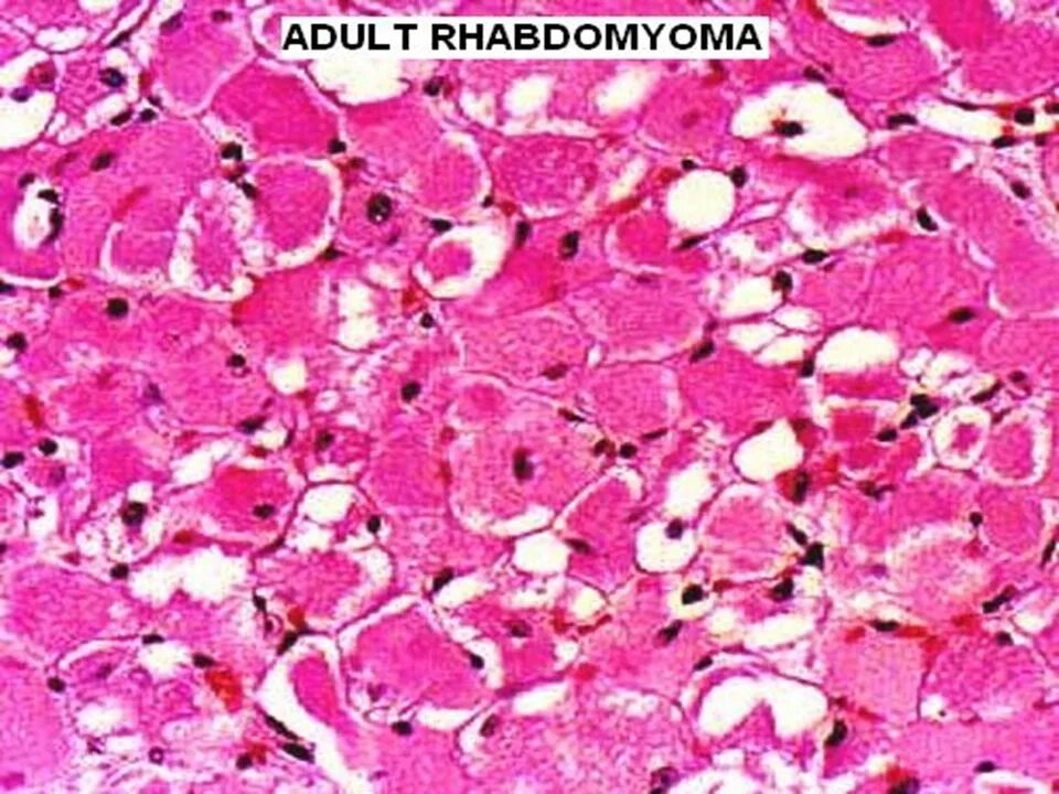 Рабдомиома сердца. Рабдомиома гистология. Рабдомиома мягких тканей гистология. Рабдомиома микропрепарат. Рабдомиома мышечной ткани.
