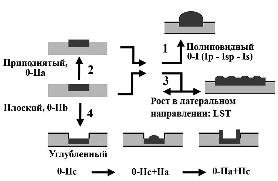 Парижская классификация эндоскопия. Парижская классификация полипов кишечника. Эндоскопическая классификация опухолей желудка. Эндоскопическая классификация полипов. Эндоскопическая классификация опухолей желудка.