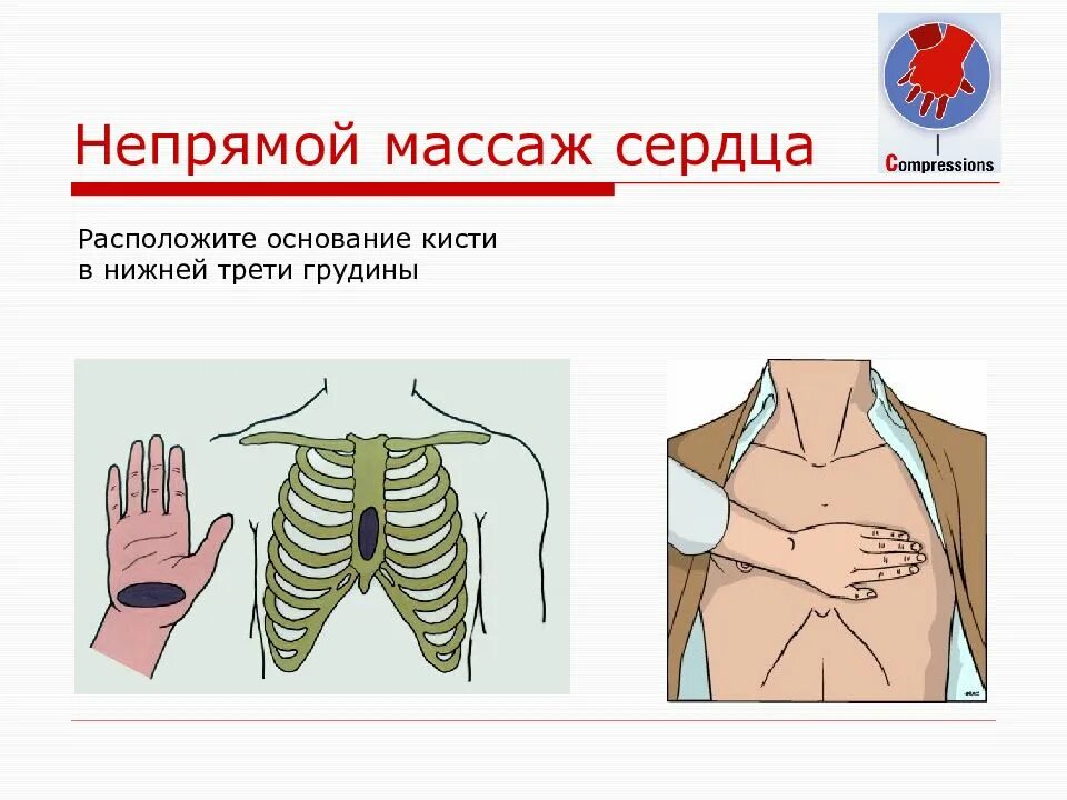 Положение рук при непрямом массаже сердца