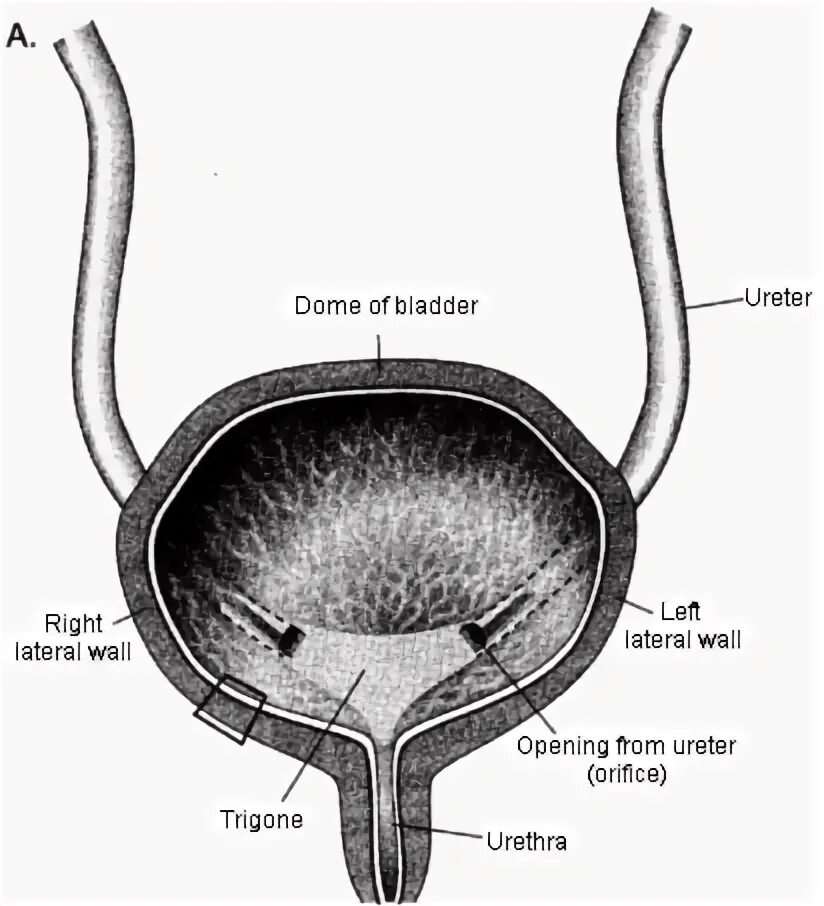 Расслабленный мочевой пузырь. Клапаны задней уретры классификация. Задний уретральный клапан. Мочевой пузырь продольный разрез.